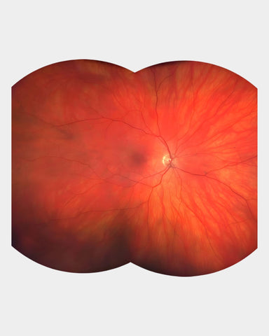 Bildgebung der Netzhaut erstellt mit ZEISS CLARUS 500 Ultraweitwinkel Funduskamera - Frontalansicht